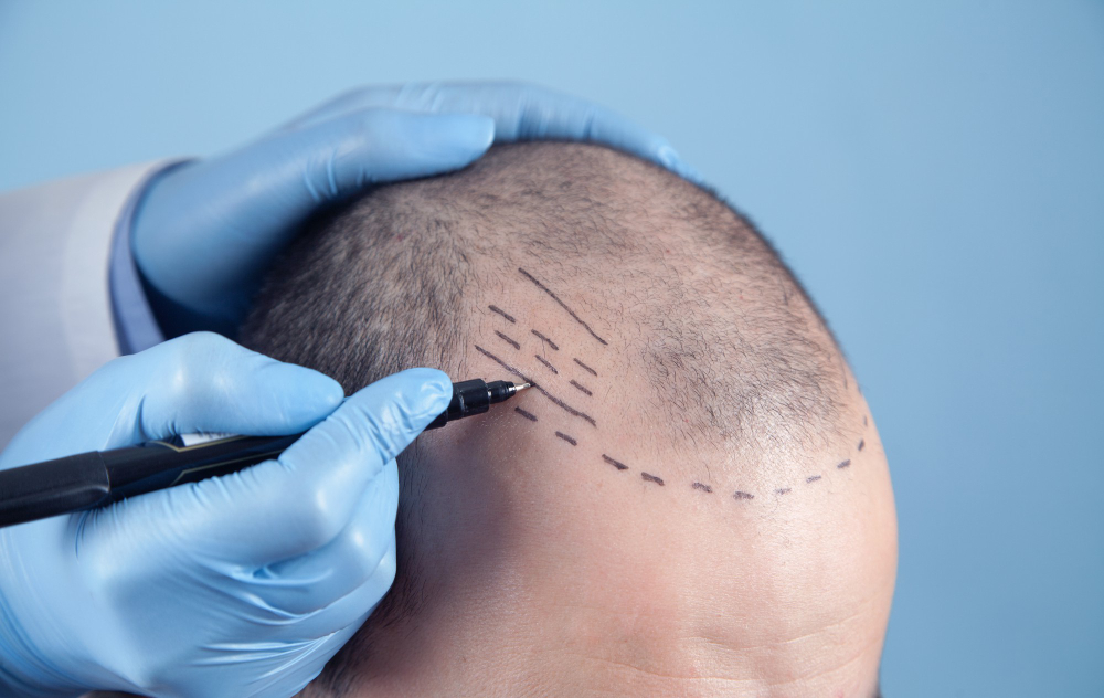 Hair Transplant Dubai | Natural Hairline Restoration